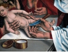 犹太人古老＂割礼＂习俗与现代包皮环切术